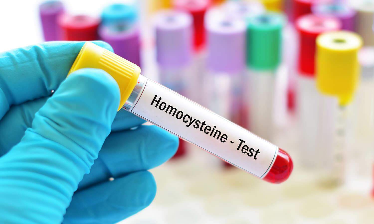 homocysteina a cholesterol